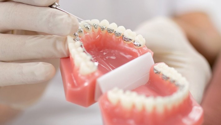 appareil lingual orthodontie